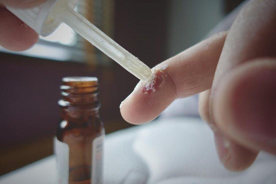 نکته بهداشتی: خلاص شدن از زگیل نکته بهداشتی: خلاص شدن از زگیل